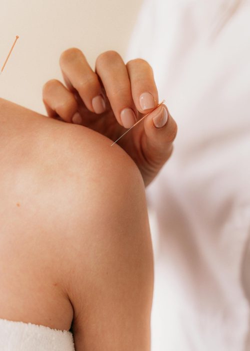 Holistic Acupuncture Therapy